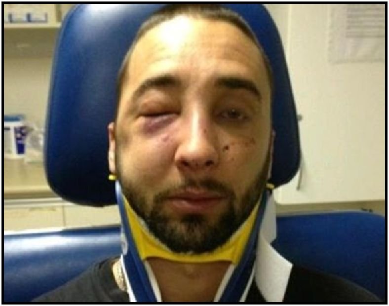Photographer Michael Farkas after Niagara Regional Police Service Constable Paul Zarafonitis punched him in the face